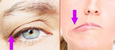مضرات تزریق سم(بوتاکس)